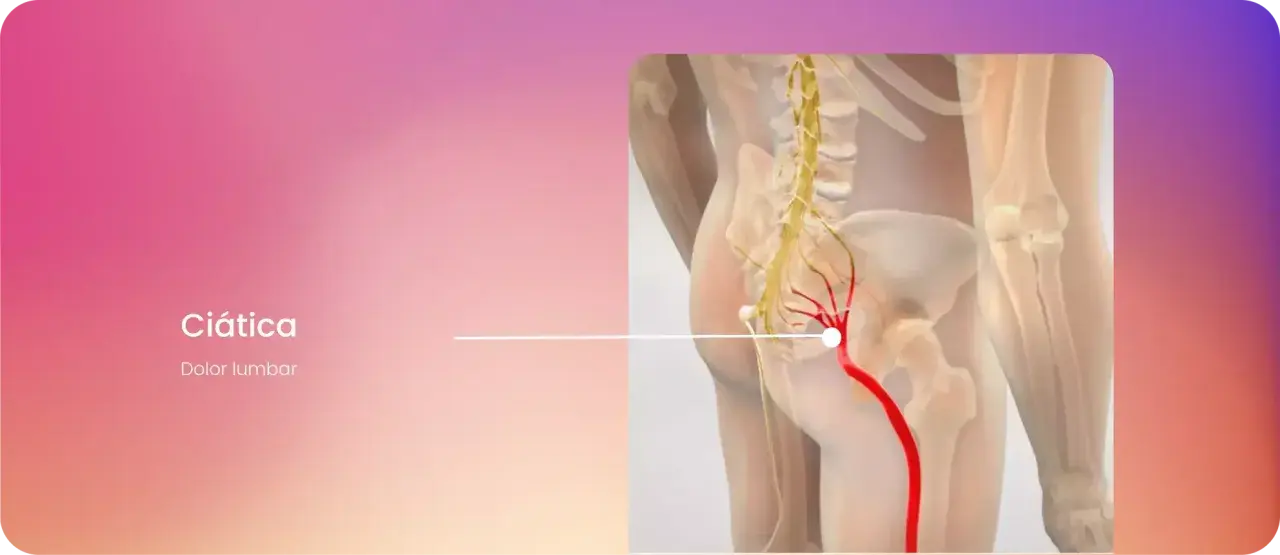 Ilustración de ciática, mostrando dolor lumbar derecho irradiado hacia adelante a lo largo del nervio ciático.