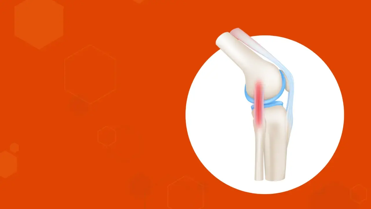 Ilustración de rodilla con tendinitis en el ligamento lateral externo, marcada en rojo.