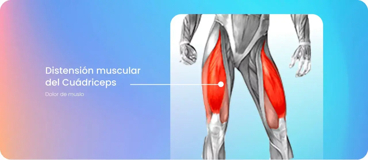 Anatomía del cuádriceps con el vasto interno inflamado, indicando dolor de muslo.