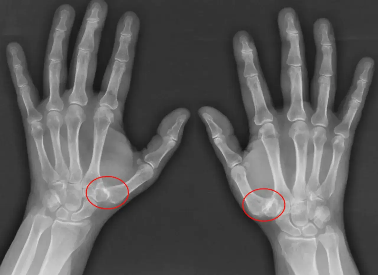 Radiograf&iacute;as de ambas manos mostrando rizartrosis grados avanzados en la base del pulgar, con deformidad &oacute;sea y estrechamiento articular.