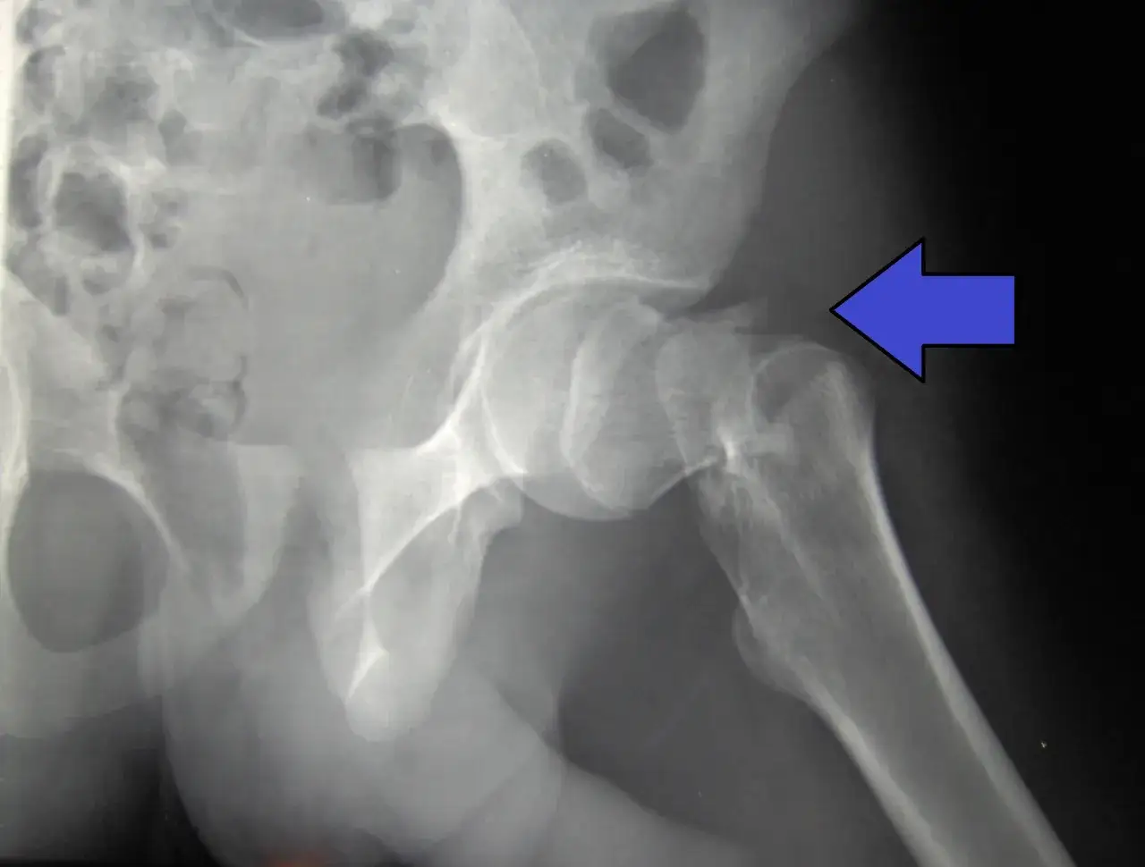 Radiografía de cadera que muestra una fractura en el cuello femoral, señalada por una flecha azul.