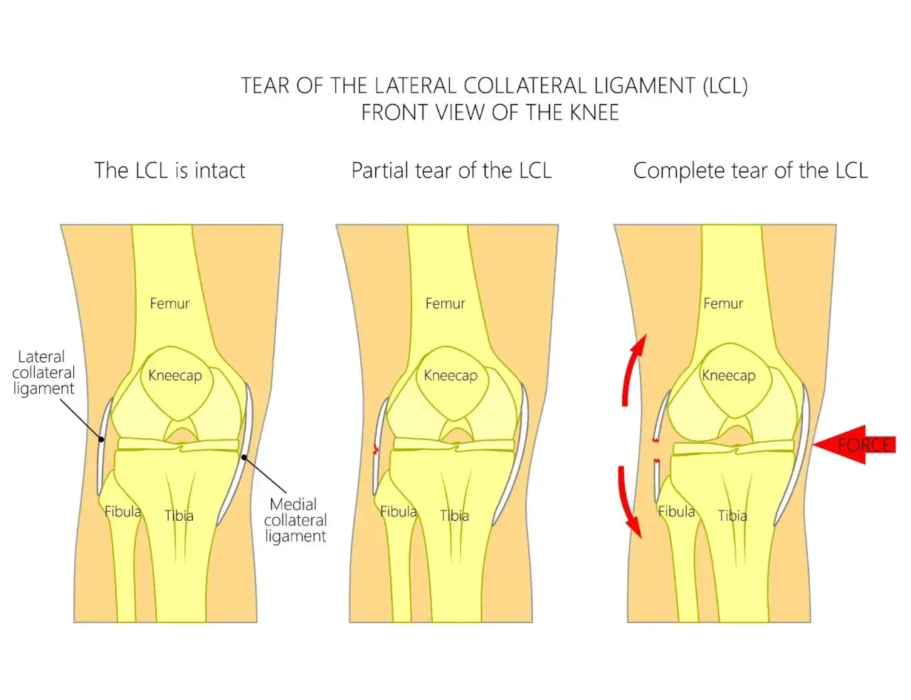 Ilustraci&oacute;n muestra la rodilla con ligamento lateral externo intacto, parcialmente roto y completamente roto. La tendinitis del ligamento lateral externo puede ser causada por fuerza.
