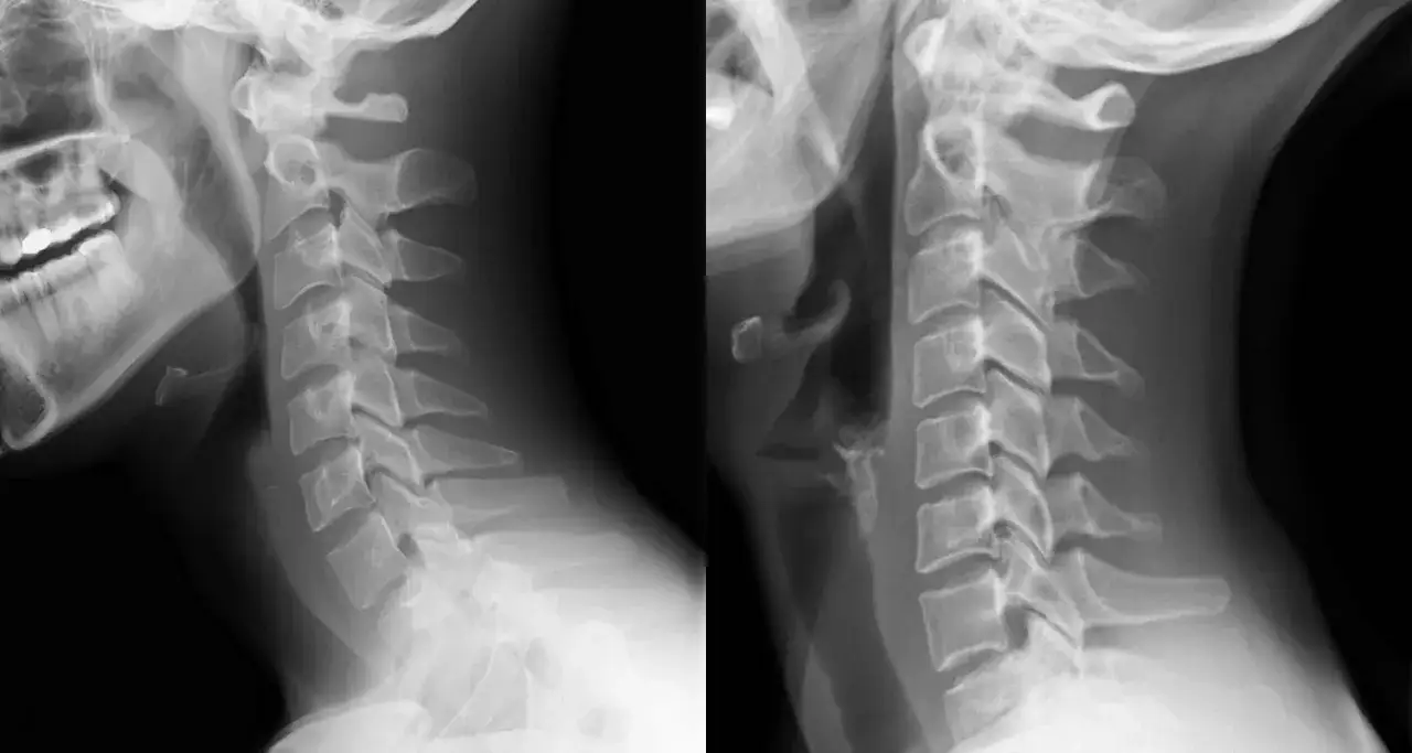 Radiograf&iacute;as laterales de columna cervical. La imagen de la izquierda muestra una lordosis cervical normal, mientras que la de la derecha evidencia un cuello rectificado, con p&eacute;rdida de la curva natural.