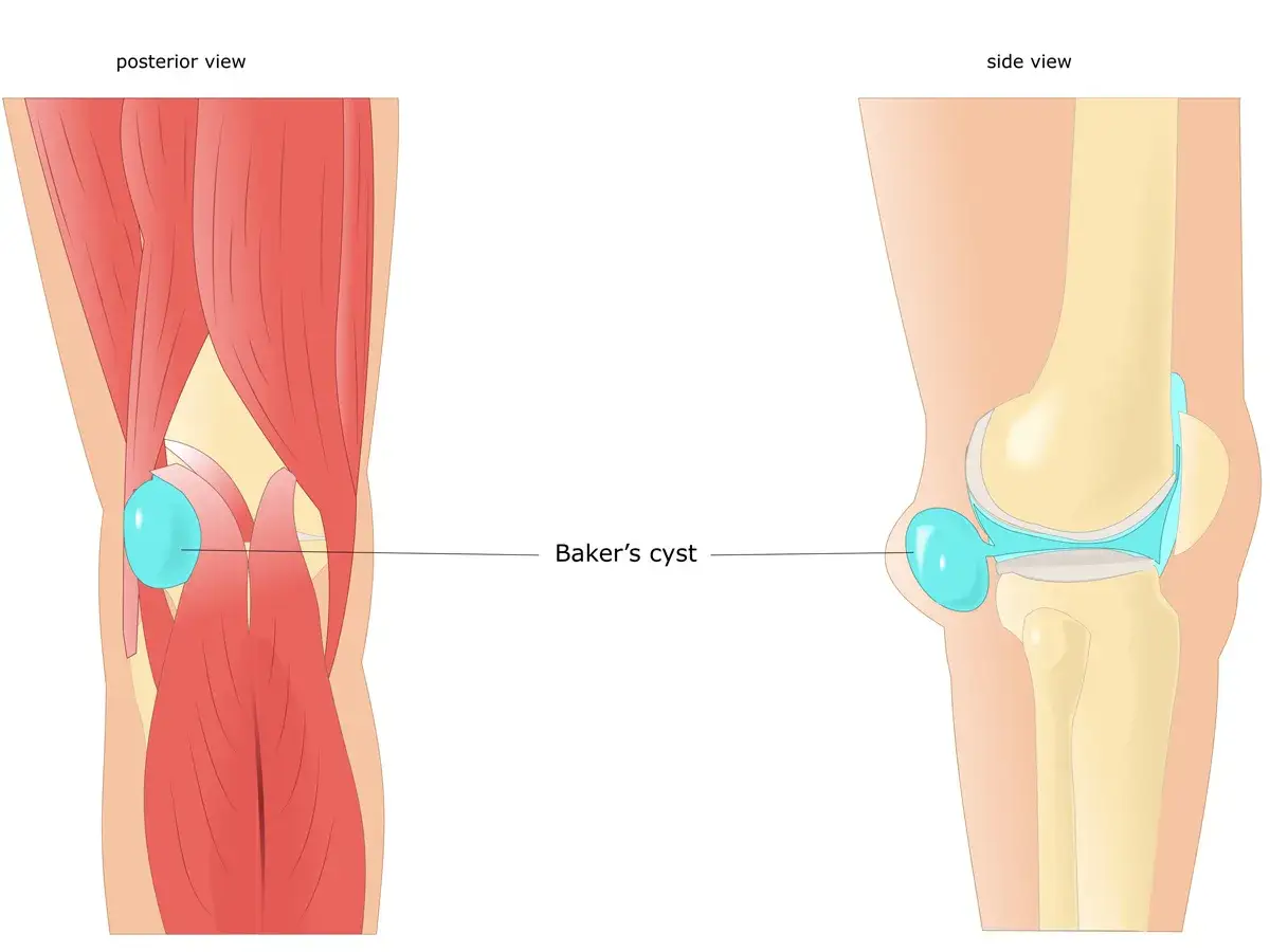 Anatom&iacute;a de la rodilla mostrando un quiste de Baker. Se puede caminar con quiste de Baker, aunque puede causar molestias.