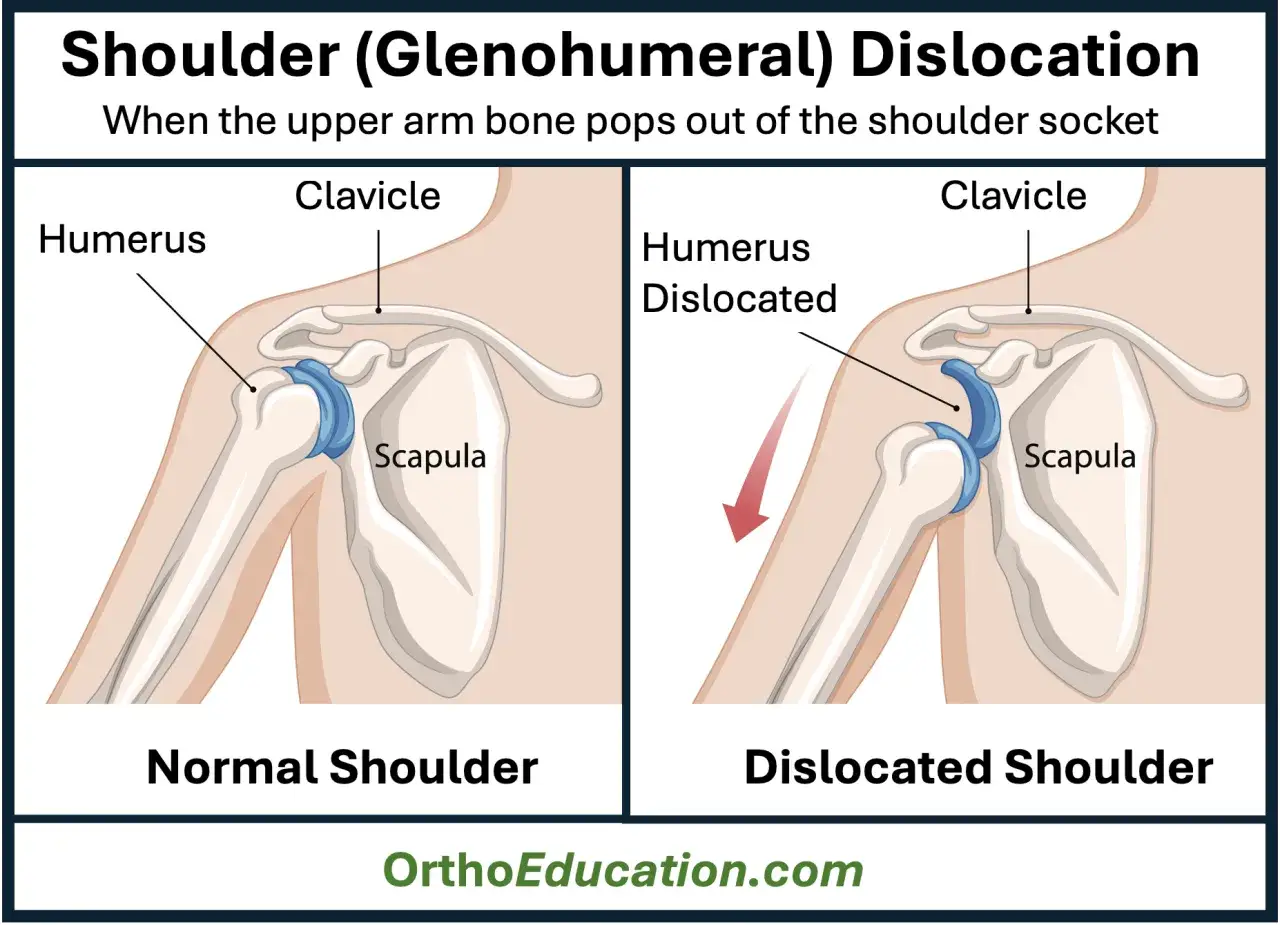 Ilustración comparativa de un hombro normal y uno con luxación glenohumeral. El húmero se sale de la escápula.