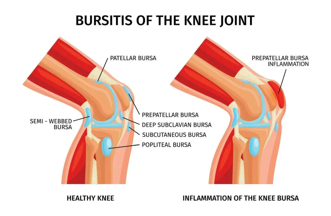 Ilustraci&oacute;n comparativa de una rodilla sana y una rodilla con bursitis. Muestra la inflamaci&oacute;n de la bursa prepatelar, causa com&uacute;n de bursitis rodilla.