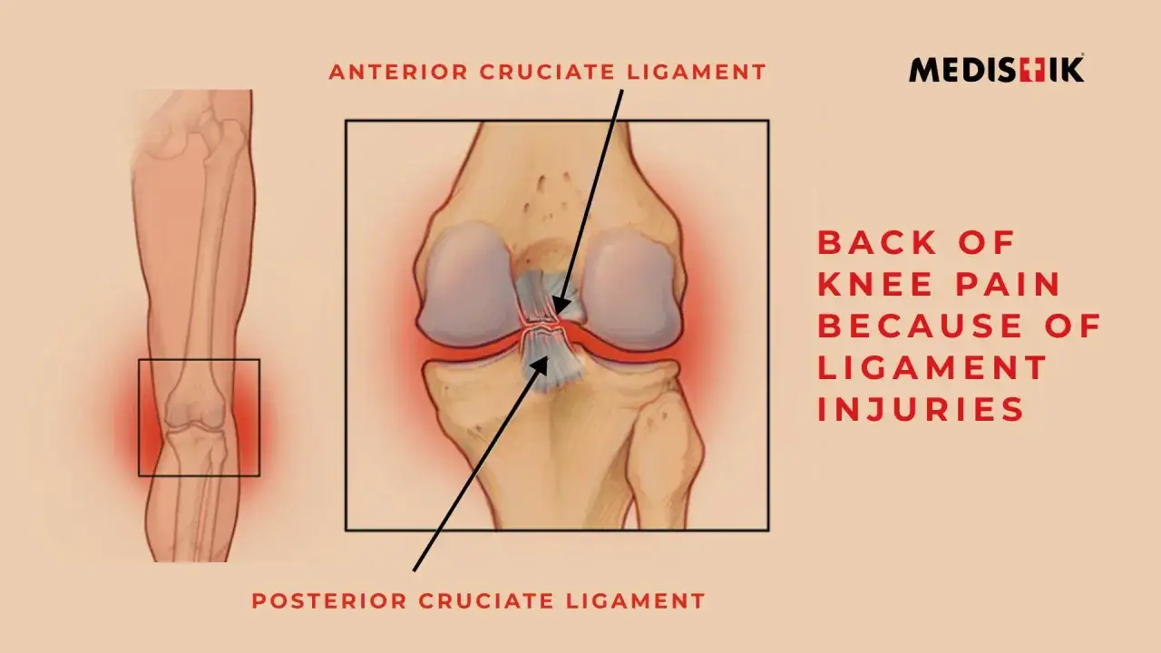 Ilustración de rodilla con ligamentos. El dolor parte trasera rodilla al caminar puede ser por lesión de ligamentos.