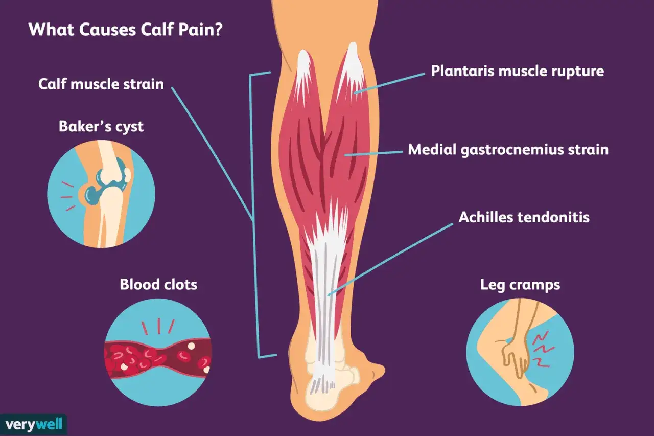 Ilustración de una pierna mostrando el músculo sóleo y otras causas de dolor en la pantorrilla, como desgarros musculares y tendinitis.