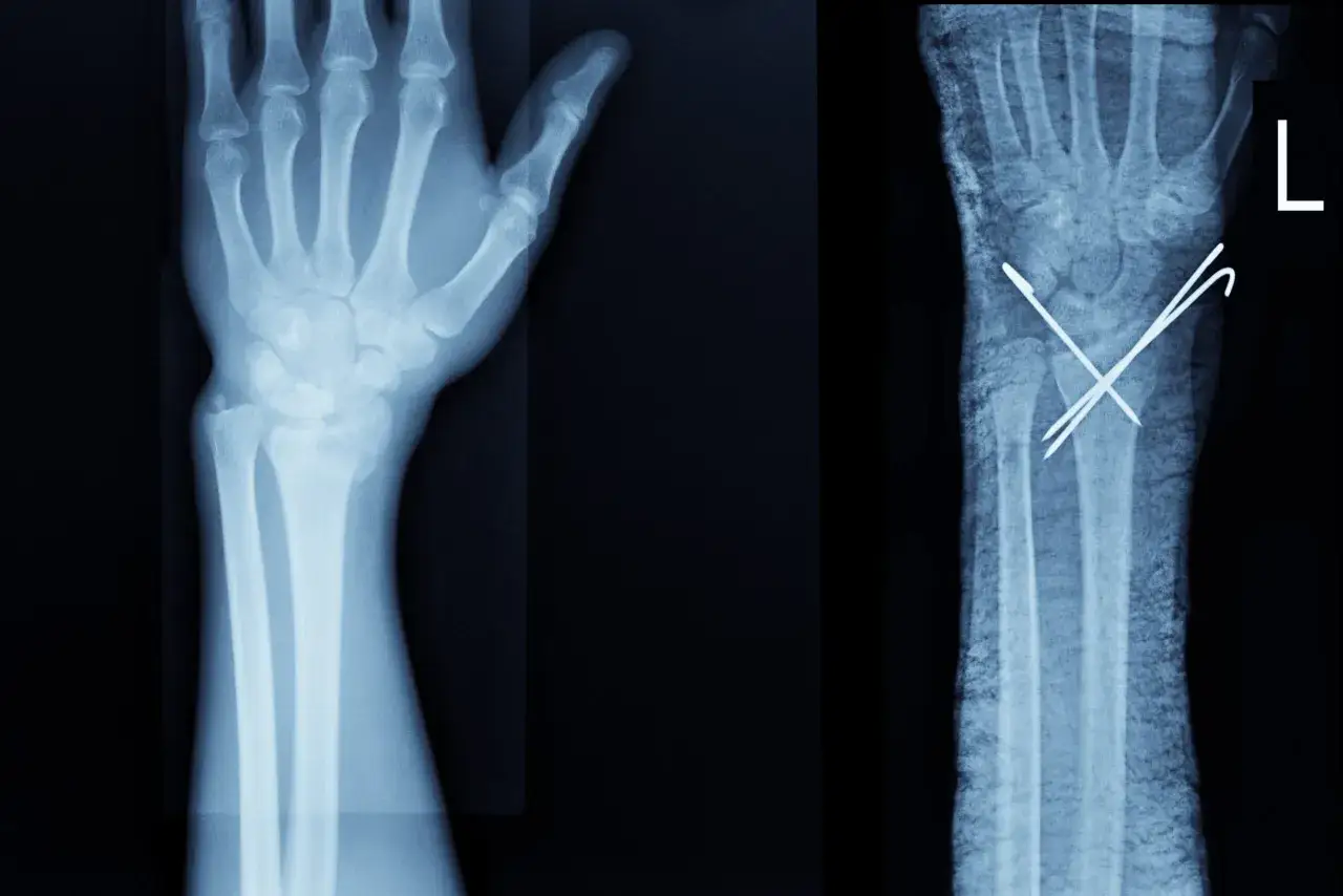 Radiografía de mano izquierda con fractura de escafoides y fijación con agujas.