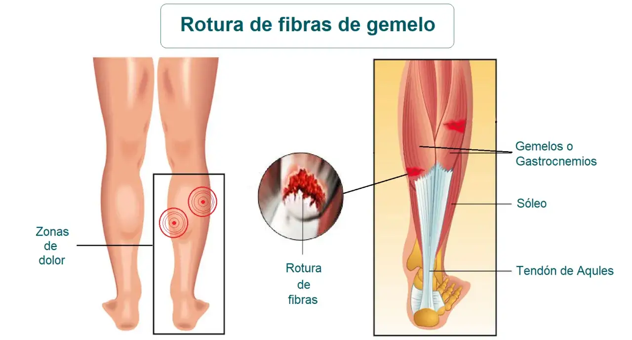 Ilustración de las secuelas de rotura fibrilar gemelo, mostrando zonas de dolor y detalle de la rotura.