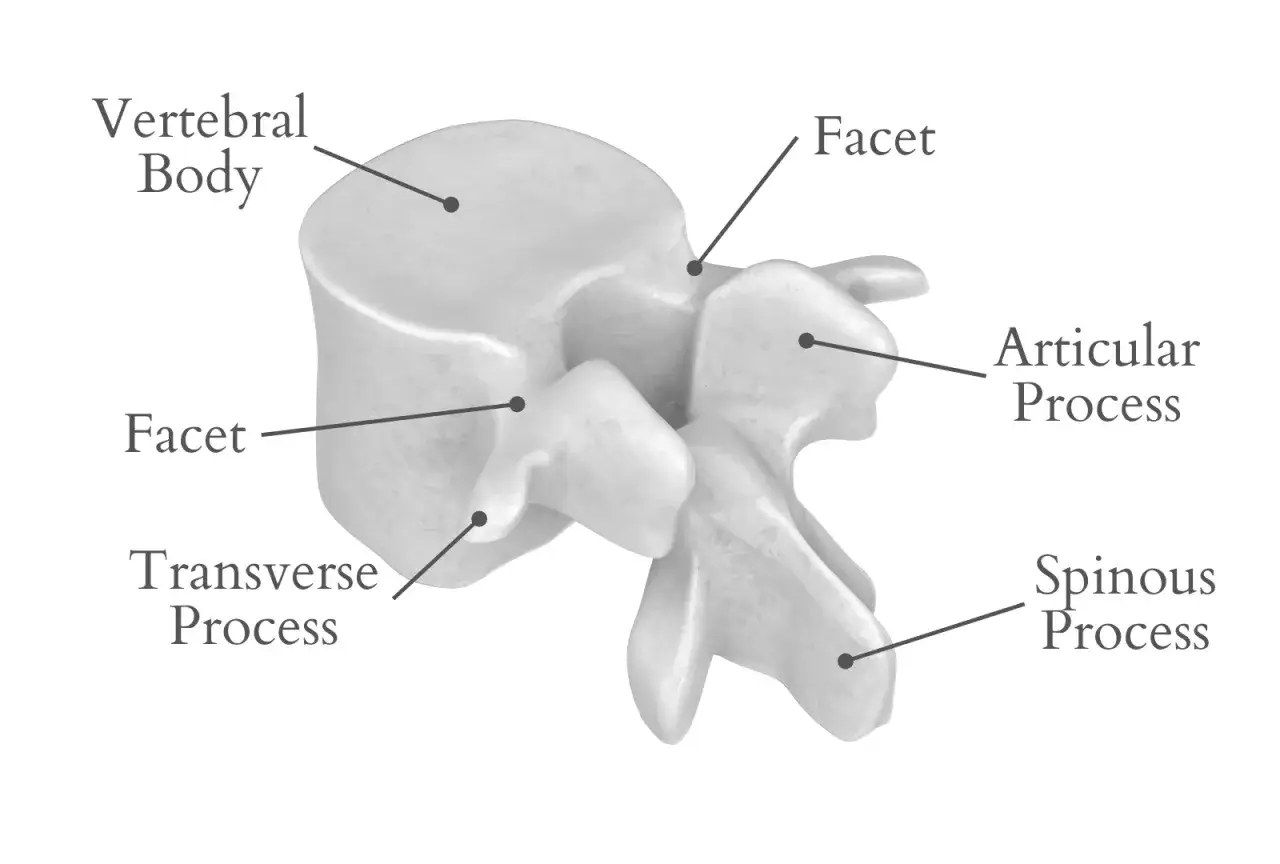 Anatomía de una vértebra, mostrando el cuerpo vertebral, apófisis transversa, apófisis espinosa y facetas. La hipertrofia de articulaciones interapofisarias puede requerir tratamiento.