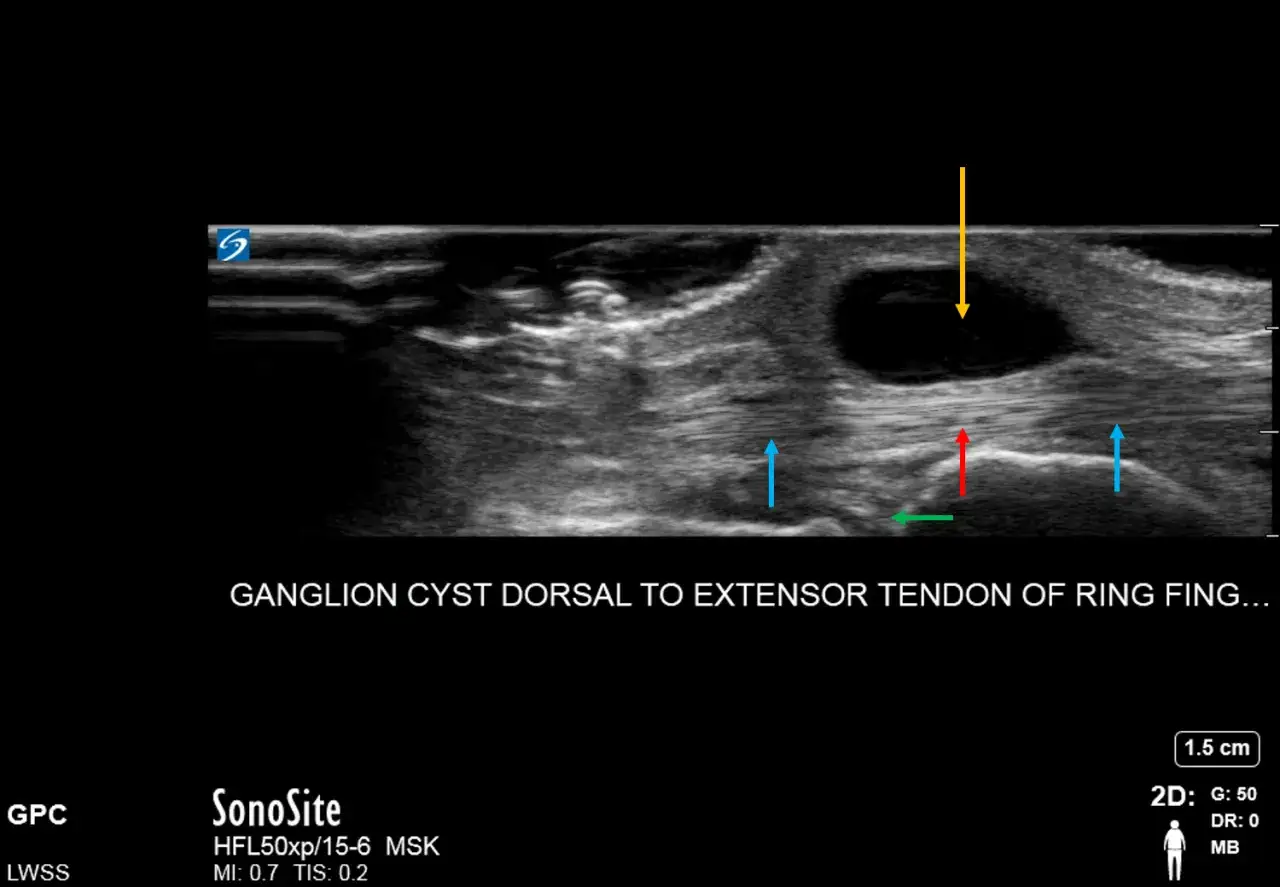 Ecograf&iacute;a muestra un ganglion mu&ntilde;eca operacion con flechas se&ntilde;alando el quiste y el tend&oacute;n.