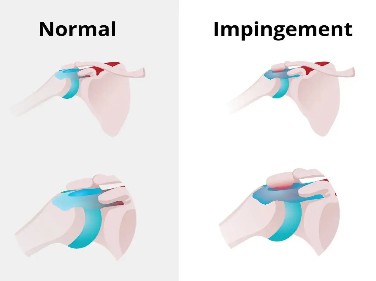 Comparaci&oacute;n de hombro normal y con impingement subacromial. El hombro con impingement muestra compresi&oacute;n y dolor en la zona.