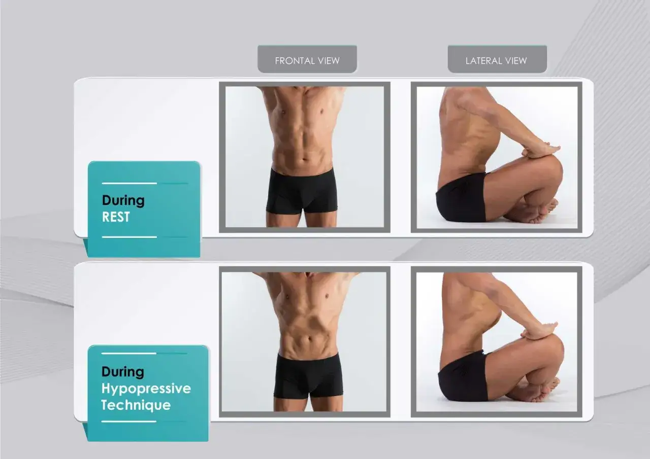 Comparaci&oacute;n de abdomen en reposo y durante abdominales hipopresivos. Se observa la succi&oacute;n abdominal.