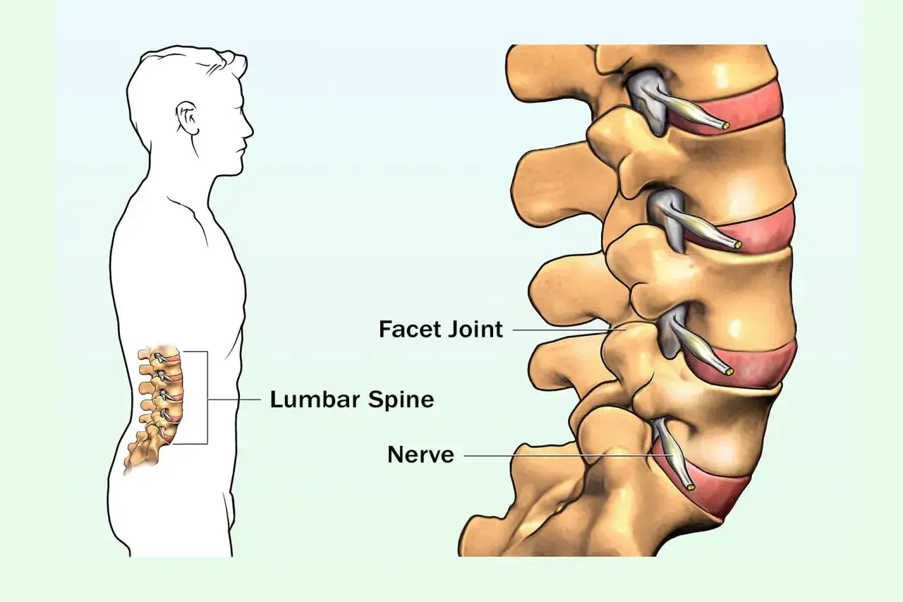 Ilustraci&oacute;n de la columna lumbar y sus articulaciones facetarias. La hipertrofia facetaria puede causar dolor.