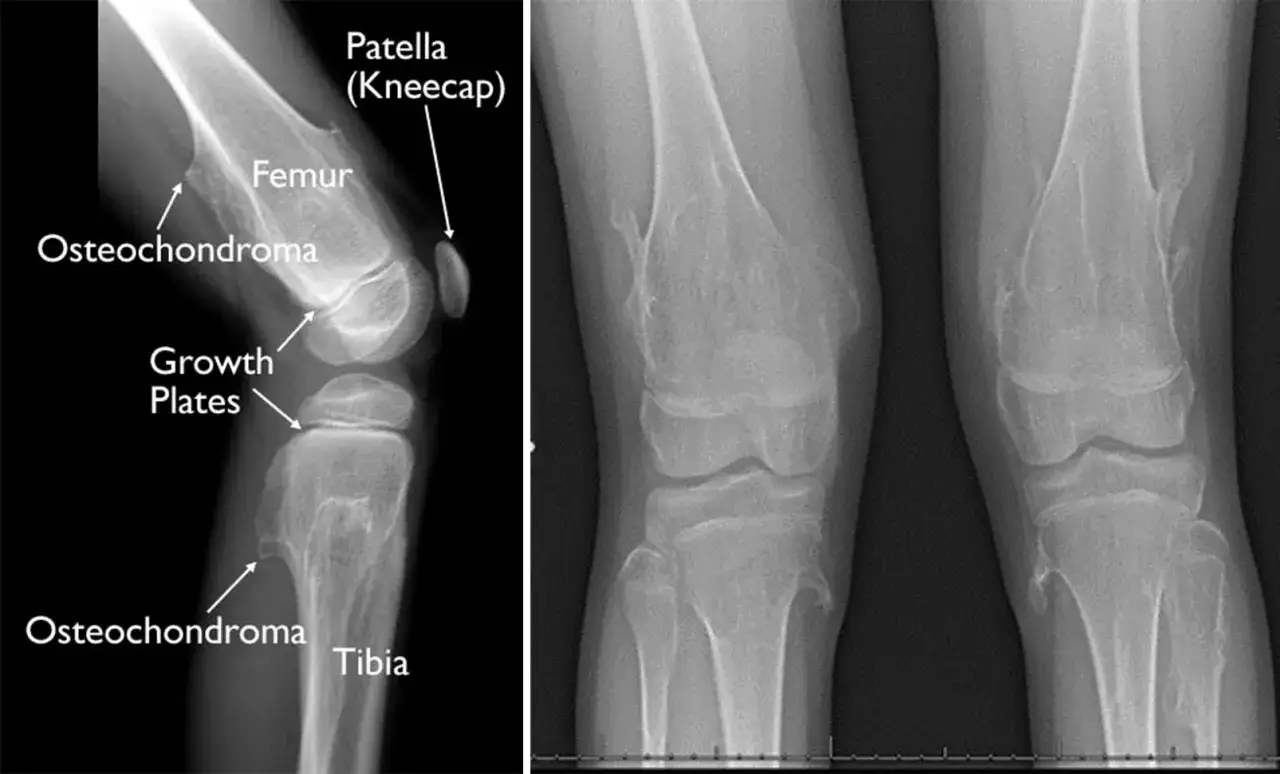 Radiografías de rodilla que muestran un osteocondroma en el fémur y la tibia, cerca de las placas de crecimiento.