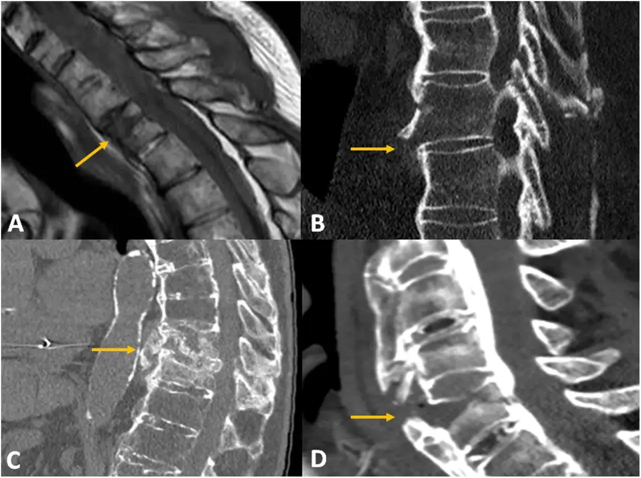 Imágenes de resonancia magnética y tomografía computarizada de columna cervical. La flecha amarilla señala una fractura en la vértebra C5, indicando un posible tac cervical complicado.