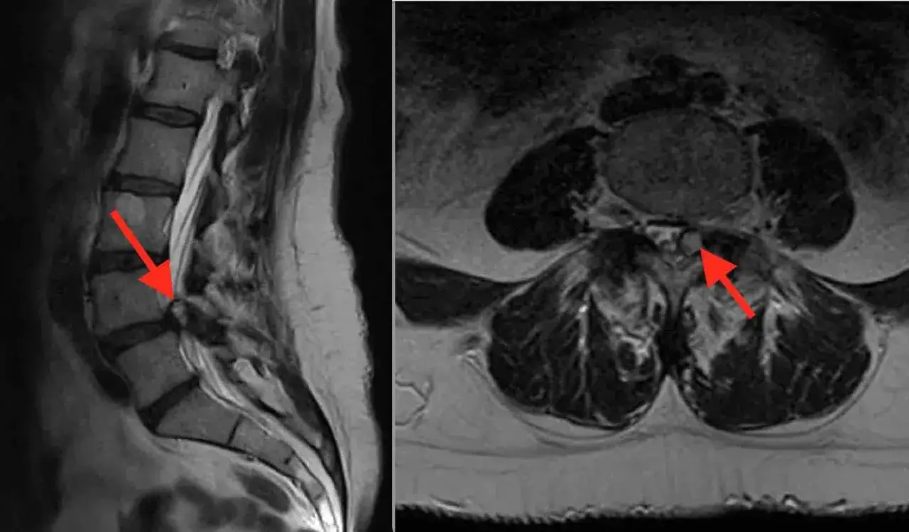 Resonancia magnética lumbar: corte sagital y axial muestran inflamación en la articulación facetaria, indicando sinovitis facetaria.
