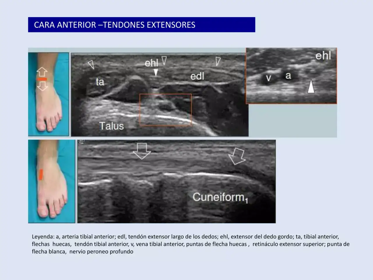 Ecograf&iacute;a del tobillo: muestra tendones extensores, arteria y vena tibial anterior, y el nervio peroneo profundo.