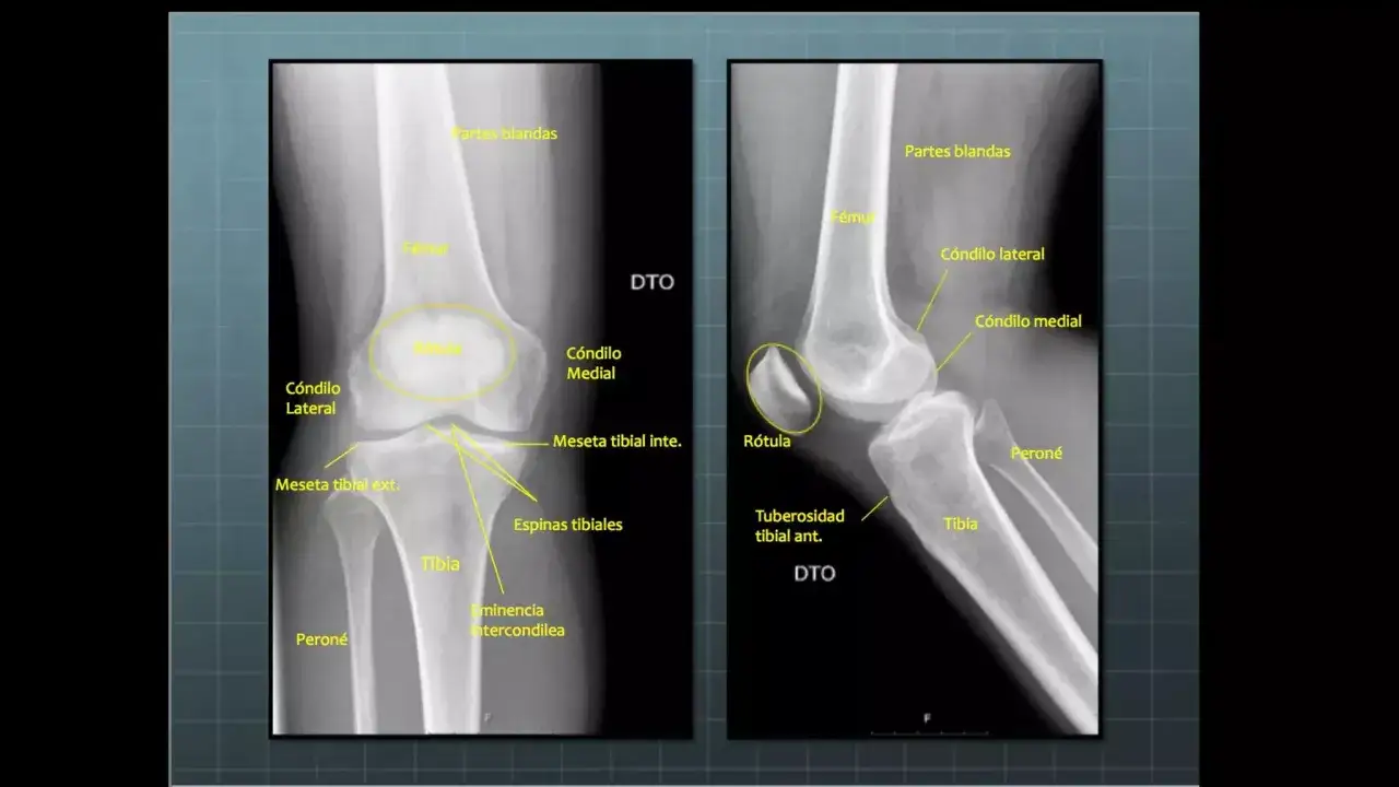 Radiografías de rodilla. Se observa el cuerno posterior del menisco interno en la vista anteroposterior, junto a la meseta tibial interna.
