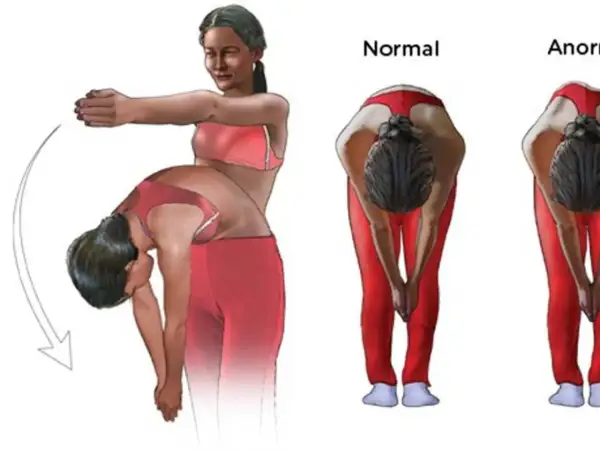Ilustración de ejercicios para escoliosis: una chica se inclina, mostrando la diferencia entre una espalda normal y una anormal.