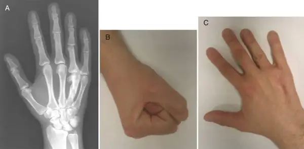 Radiografía de mano (A) mostrando un hueso metacarpiano fracturado, un puño cerrado (B) y una mano abierta (C).