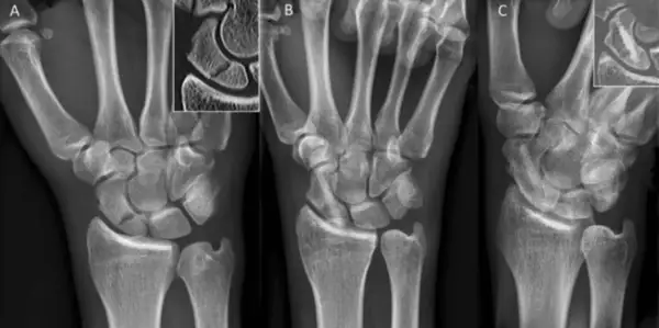 Radiografías de mano que muestran el escafoides. La imagen A es una vista anteroposterior, B una vista lateral y C una vista oblicua.