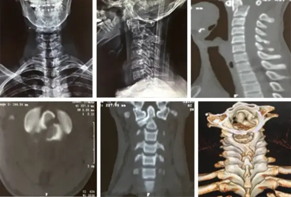 Radiografías y tomografías de columna cervical, mostrando la apófisis odontoides y posibles fracturas.