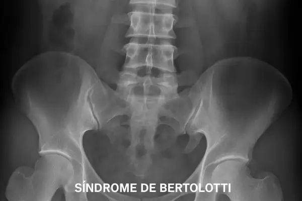 Radiografía pélvica que muestra la sacralización de L5, una anomalía vertebral que puede causar dolor lumbar.
