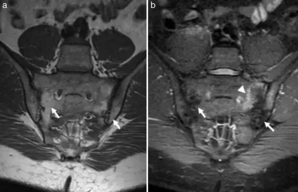 Resonancia sacroiliaca: imagen (a) muestra hallazgos normales, mientras que (b) revela inflamación y edema en la articulación sacroiliaca izquierda (flechas y triángulo).