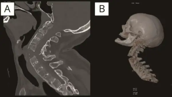 Corte sagital y reconstrucción 3D de columna cervical mostrando una grave fractura cervical.