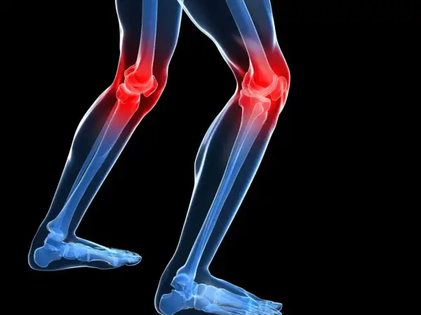 Ilustración de unas piernas con las rodillas en rojo, indicando dolor. De repente me falla la rodilla al caminar.