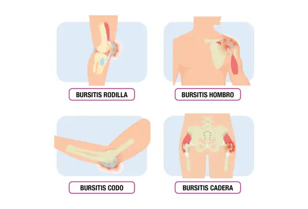 Ilustraciones de bursitis en rodilla, hombro, codo y cadera, mostrando inflamación en las articulaciones.