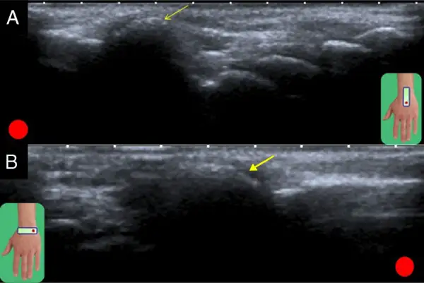 Ecografía muestra un carpal boss, una protuberancia ósea en la muñeca, con flechas señalando la zona afectada.