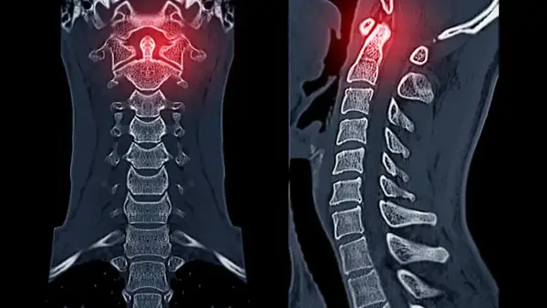 TAC cervical muestra una lesión en las vértebras superiores, resaltada en rojo.