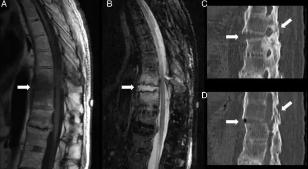 Resonancia magnética y tomografía de columna vertebral. La resonancia muestra cambios degenerativos, indicativos de artrosis lumbar.