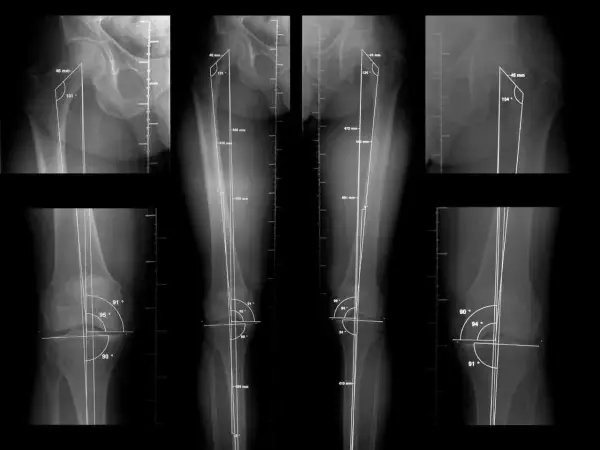 Radiografías de miembros inferiores con mediciones angulares y de longitud para telemetria.