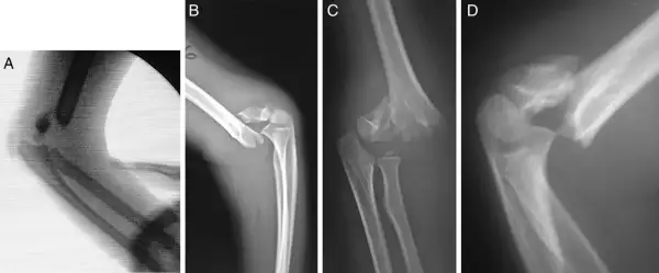 Radiografías de codo muestran una fractura supracondilea con desplazamiento y fragmentación ósea, indicando una lesión compleja.