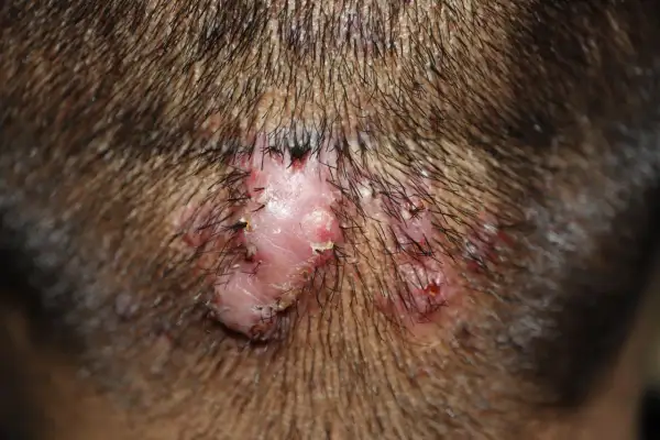 Un bulto en la nuca con varias lesiones rosadas y costras, rodeado de cabello oscuro.