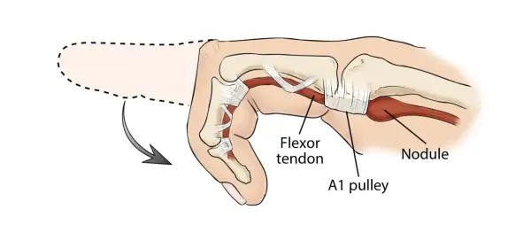 Anatomía del dedo en gatillo: un tendón flexor engrosado y un nódulo impiden el movimiento suave a través de la polea A1.