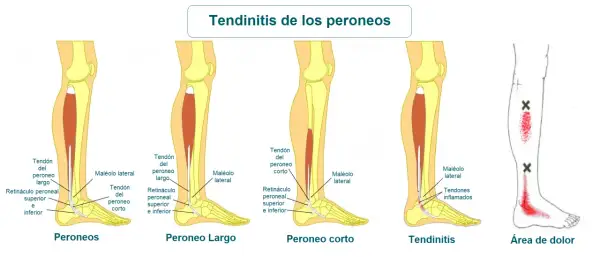 Ilustración de la anatomía del tobillo y la pierna, mostrando el tendón peroneo lateral largo y la tendinitis.