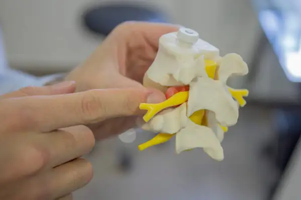 Modelo de vértebras y nervios, mostrando la distribución de los dermatomas cervicales.