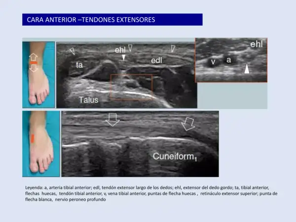 Ecografía del tobillo: muestra tendones extensores, arteria y vena tibial anterior, y el nervio peroneo profundo.