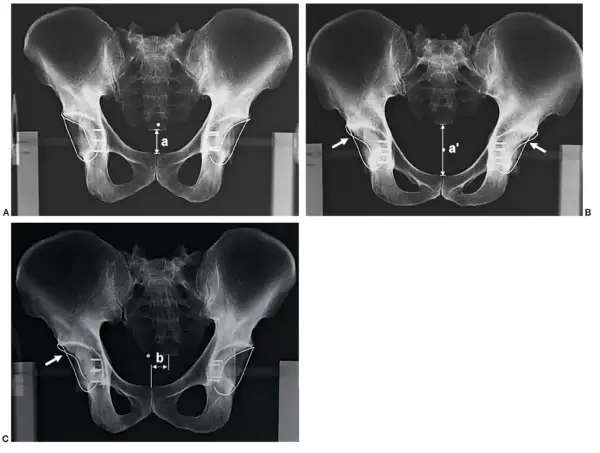 Radiografía de cadera que muestra mediciones y fijaciones. La imagen A compara la distancia 'a'. La imagen B muestra la distancia 'a'' y la flecha indica un implante. La imagen C muestra la distancia 'b' y una flecha señala un implante.