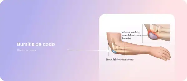 Ilustración de la bursitis de codo, mostrando la inflamación de la bursa del olécranon.