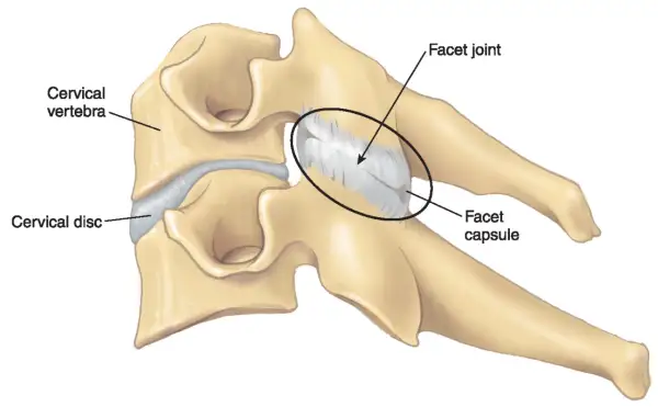 Ilustración de vértebras cervicales y disco, destacando la articulación facetaria y su cápsula, relevante para entender la sinovitis facetaria.