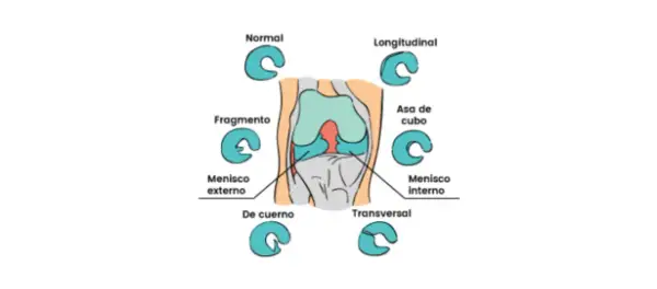 Ilustración de rodilla con diferentes tipos de lesiones meniscales, incluyendo el cuerno posterior del menisco interno.
