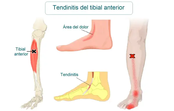 Ilustración médica que muestra la tendinitis tibial anterior, con el músculo tibial anterior marcado y áreas de dolor en el pie y la espinilla.