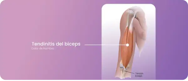 Ilustración de la tendinitis del bíceps, mostrando el tendón del bíceps y el dolor de hombro asociado.