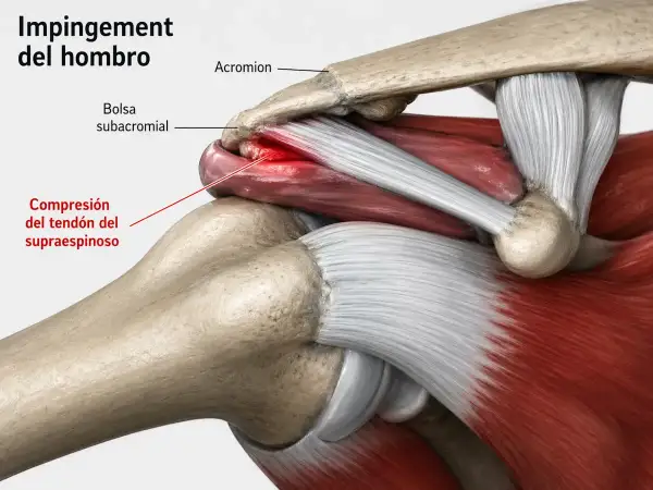 Ilustración anatómica del **impingement subacromial** en el hombro, mostrando la compresión del tendón del supraespinoso.